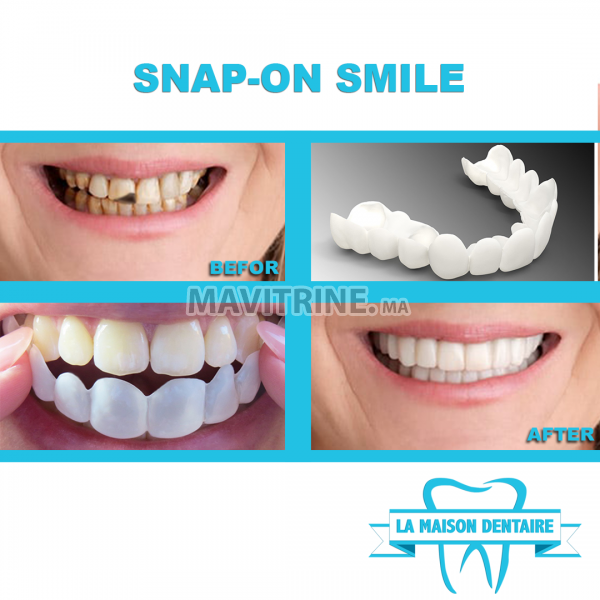 SNAP ON SMILE ET APPAREIL VALPLAST